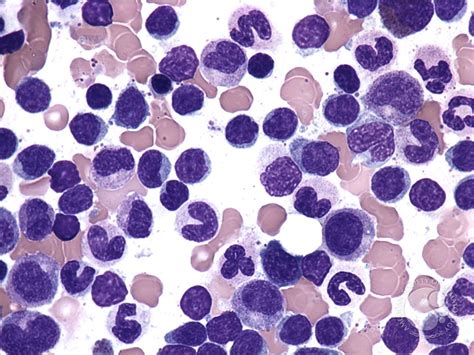 Peripheral T Cell Lymphoma Unspecified Bone Marrow Aspirate 2