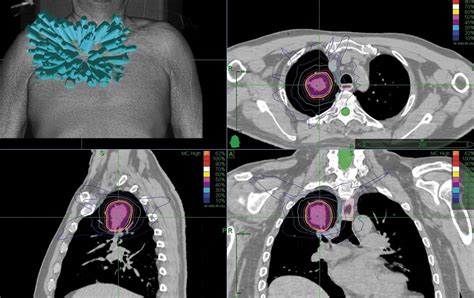 Sbrt Revolution In Lung Radiotherapy Medical Forum