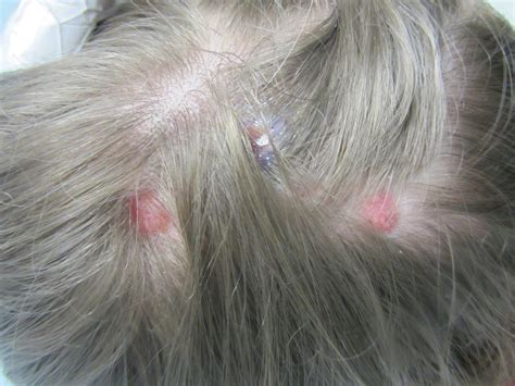 Lamotrigine Induced Cutaneous Pseudolymphoma Mdedge Dermatology