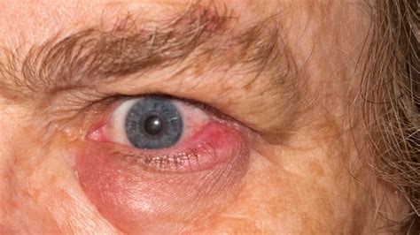 Infected Eye Types Causes And Treatment 58d