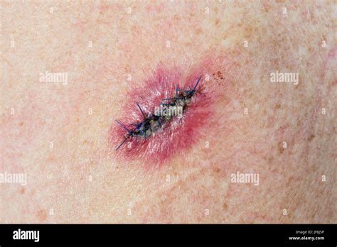Medical Stitches Stock Photos And Medical Stitches Stock Images Alamy