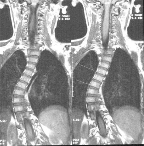 Mri T Weighted Coronal Plane Image Idiopathic Scoliosis Patient My