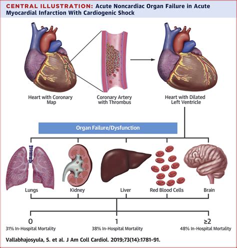Acute Noncardiac Organ Failure In Acute Myocardial Infarction With