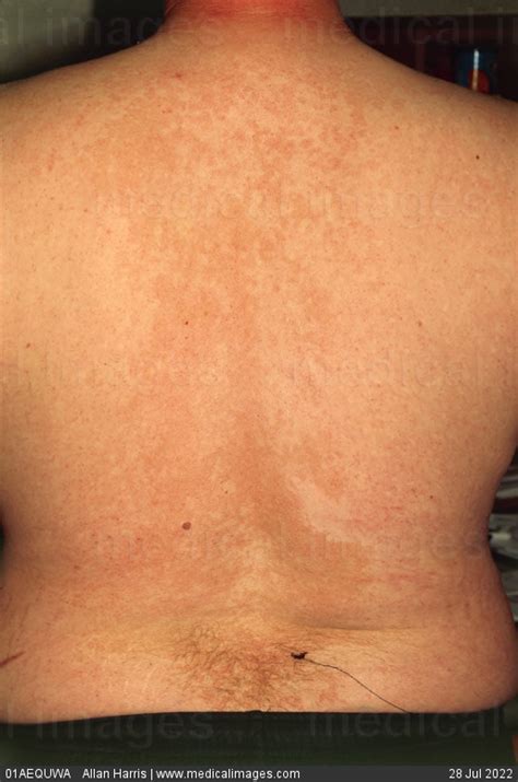 Stock Image Tinea Versicolor Also Called Pityriasis Versicolor A