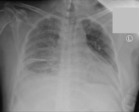 Cureus An Uncommon Presentation Of Pulmonary Tularemia A Case Report
