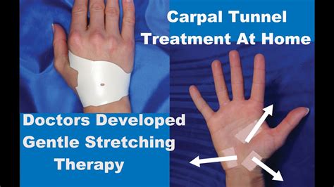 Carpal Tunnel Syndrome Relief Without Surgery Youtube
