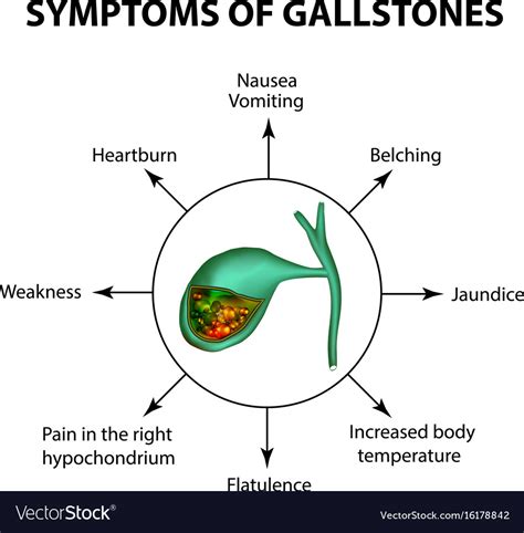 Symptoms Of Stones In The Gallbladder Royalty Free Vector