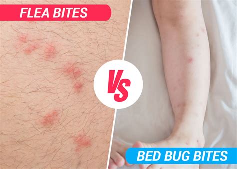Bed Bug Vs Flea Bites