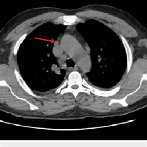 Ct Scan Of The Chest Showing Enlarged Mediastinal And Axillary Lymph