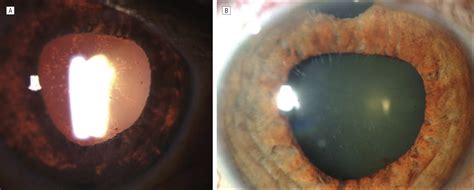 An Unusual Manifestation Of Herpes Simplex Virusassociated Acute Iris