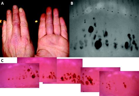 Achenbachs Syndrome Paroxysmal Finger Hematoma With Capillaroscopic