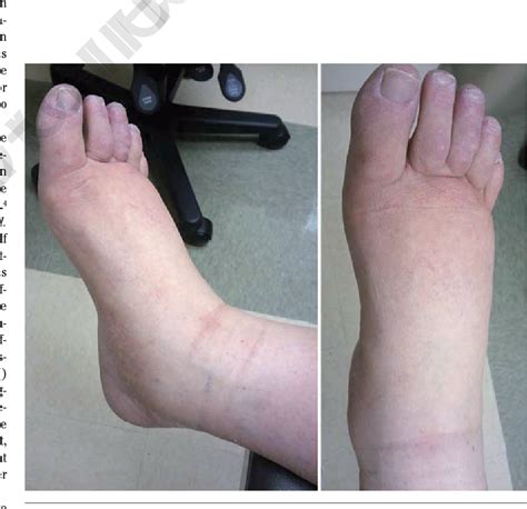 Figure 1 From Lower Extremity Swelling In A Patient With Psoriatic