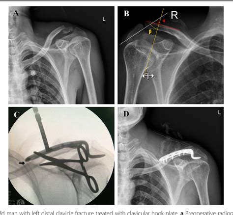 Relationship Between The Lateral Acromion Angle And Postoperative