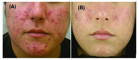 Acne Treatment With Blue Light And Endogenous 5 Aminolevulinic Acid