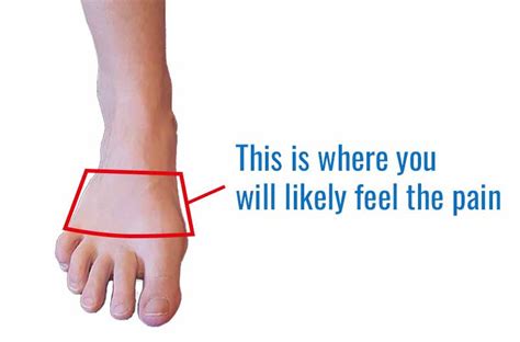 Metatarsal Stress Fractures Causes Symptoms And Treatment