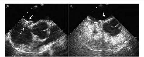 Figure 4 From Percutaneous Closure Of Patent Foramen Ovale In A Patient