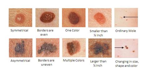 Melanoma Symptoms Causes Stages And Treatments Available