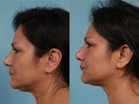 Neck Lift Before And After Photos Patient 227 Chicago Il Tlkm