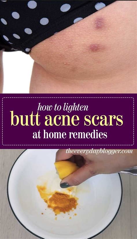 Pin On Natural Scar Remedy