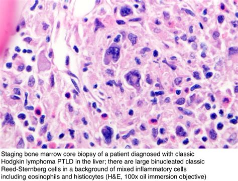 Pathology Outlines Classic Hodgkin Lymphoma Ptld