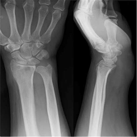 Lateral Wrist X Ray Labeled
