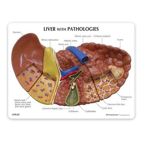 Liver Model Human Body Anatomy Replica Of Liver Wpathologies For