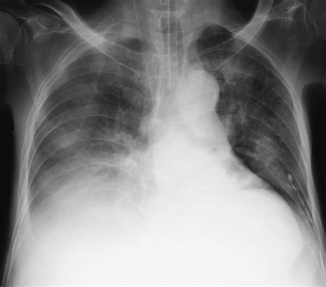 Chest X Ray Shows Right Pleural Effusion And Bilateral Infiltrative