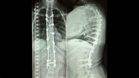 My Scoliosis Surgery Story Youtube