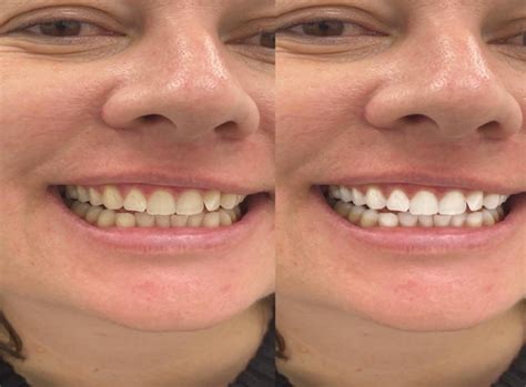Finest Dental Studio In Winchmore Hill Cosmetic And Dental Implants