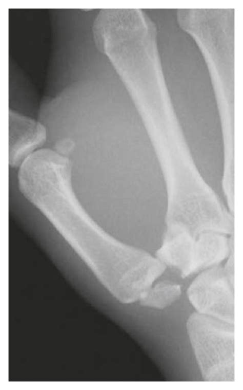 A B Radiographs Taken At The Initial Presentation The Trapezium