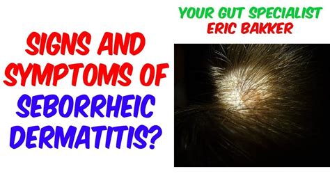 Signs And Symptoms Of Seborrheic Dermatitis Youtube