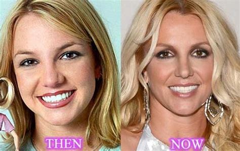 Britney Spears Before And After Plastic Surgery 02 Azra Magazin