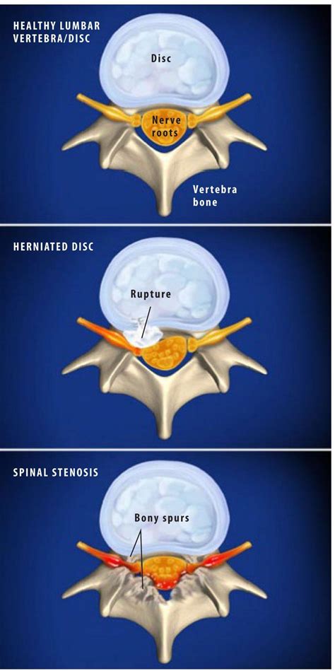 Lumbar Radiculopathy Stephen P Courtney Md Orthopedic Spine Surgeon Plano Tx Advanced