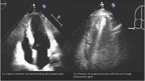 Apical Hypertrophic Cardiomyopathy With Apical Aneurysm An Emerging