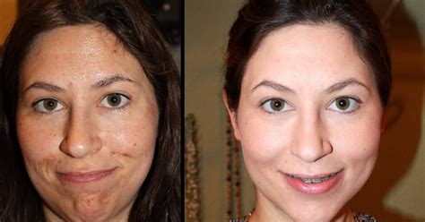 Jessner Peel Photos A Blogger S Before After Guide To Chemical Peels