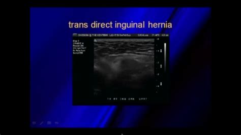 Ultrasound Of Hernias Ultrasound Desktop Screenshot