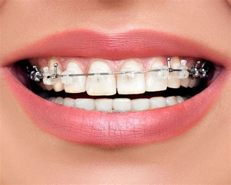 Ceramic Clear Braces Scarborough Wired Orthodontics
