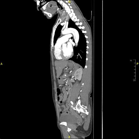 Aortic Dissection Imaging
