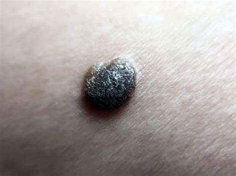 Mole Spot On Body Skin Stock Image Image Of Person