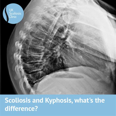 Scoliosis And Kyphosis Whats The Difference Scoliosis Clinic Uk