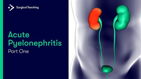 Acute Pyelonephritis What Is It And What Causes It Youtube