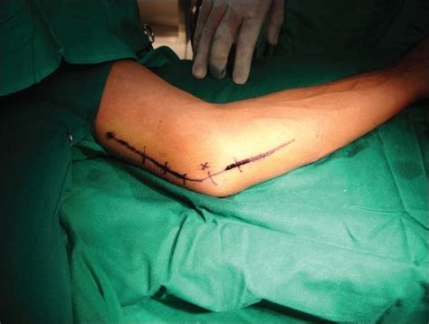 Incision For The Release Of Cubital Tunnel Syndrome Download