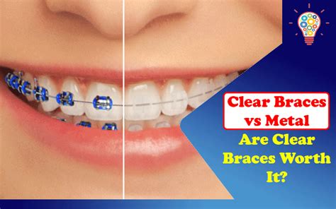 Clear Braces Vs Metal Are Clear Braces Worth It Updated Ideas
