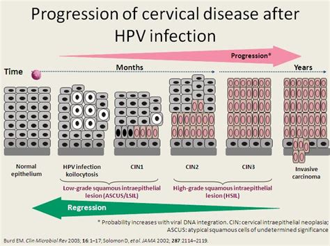 Shj Womens Health Specialist Progression Of Cervical Disease After