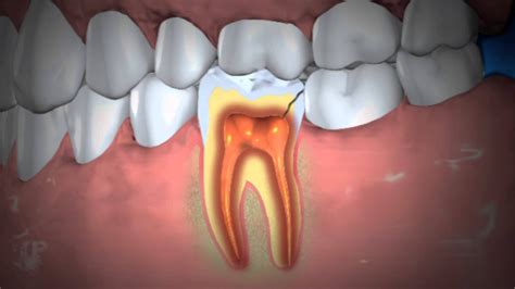 Treatment Of Abscessed Teeth Youtube