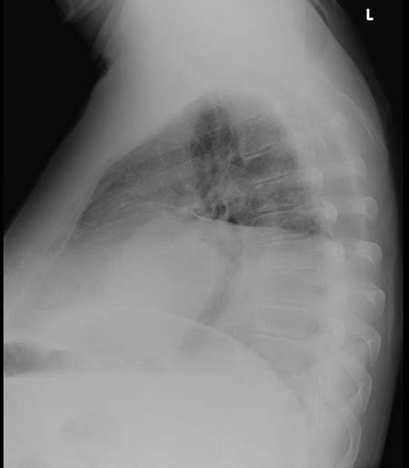 Chest Wall Tumors Thoracic Key