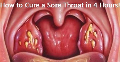 How To Cure Tonsillitis And Sore Throat In Only 4 Hours Health