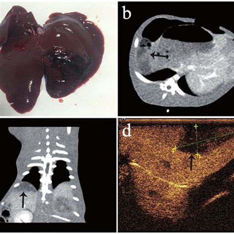 Grade II Blunt Liver Trauma A Gross Pathologic Image Of Blunt