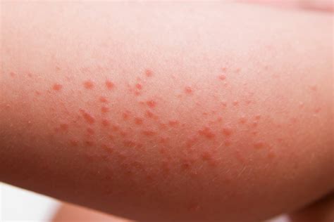 Celiac Disease Rash Dermatitis Herpetiformis Explained Good For You