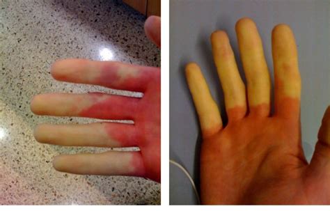 Researchers Find Genetic Cause Of Raynauds Phenomenon Queen Mary University Of London